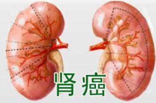 肾癌可以吃线瓜吗,线瓜的适宜与禁忌  第1张